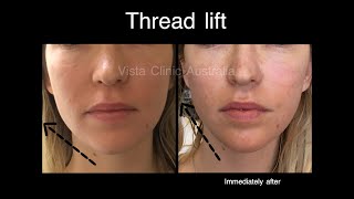 Threadlift types explanation of mono meso barbs cogs absorbable permanent Pros and cons [upl. by Naivaf908]