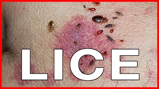 Pubic Lice or Crabs Info about Transmission Treatments Cure and Pictures [upl. by Anitnemelc280]