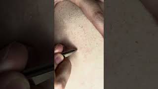 Ingrown back hairs part 8 [upl. by Ybrek]