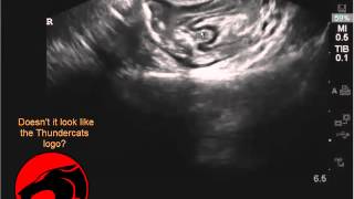 Pelvic pain diagnosis  intussusception [upl. by Ivetts762]