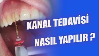 Kanal Tedavisi Nasıl Yapılır Nelere Dikkat Edilir [upl. by Assira]