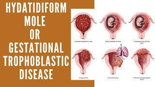 Hydatidiform Mole  Vesicular Mole  Molar Pregnancy  Gestational Trophoblastic Disease [upl. by Earas372]