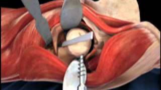 Femoral Head Osteotomy Animation  Direct Anterior Total Hip Replacement [upl. by Aicirpac]