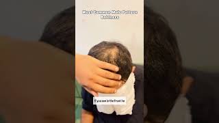 Male pattern Baldness hairtransformation hairfallsolution hairtransplant hairgrowth haircare [upl. by Armillia]