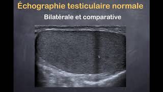 Tumeurs du testicule  1 Imagerie normale [upl. by Aronaele305]