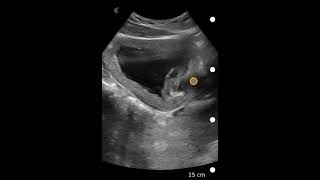 Bladder Debris Ultrasound Image Interpretation [upl. by Flan]