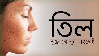 Til dur korer upay  চিরতরে মুখের ছোট ছোট কালো তিল দূর করবেন যে ভাবে। [upl. by Queen584]