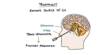 Understanding Acromegaly [upl. by Mateo176]