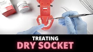 Tips For Managing Dry Socket Alveolar Osteitis  OnlineExodontiacom [upl. by Eniak]