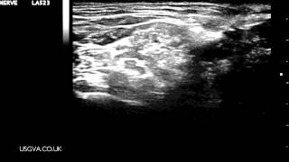 Ultrasound Guided Interscalene Brachial Plexus Block [upl. by Hughie]