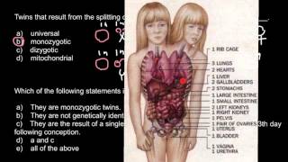 Definition of Monozygous Dizygous and Conjoined twins [upl. by Berkly]