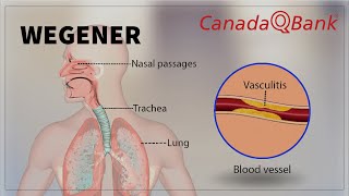 Wegener Granulomatosis [upl. by Reppep142]