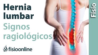 Hernia discal lumbar y protrusión discal  Signos radiológicos [upl. by Land225]