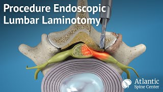 Procedure Endoscopic Lumbar Laminotomy [upl. by Nwahs]