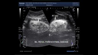 Bilateral Renal Parenchymal Disease Two videos [upl. by Elodea70]