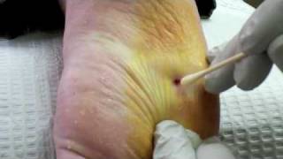 Surgical Plantar Wart Removal [upl. by Kulseth]