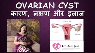 OVARIAN CYST ओवरी में गाँठ  सिस्ट HINDI Gynaecologist Dr Dipti Jain Ahmedabad [upl. by Alleber]