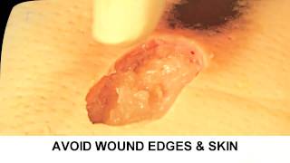 Enzymatic Debridement Demonstration Understand Wound Care [upl. by Nicki314]