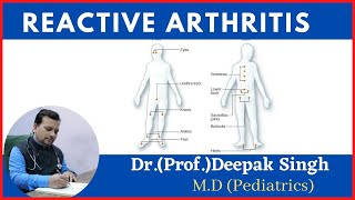 Reactive arthritis  reiter syndrome  Deepak PD Singh [upl. by Elazaro]