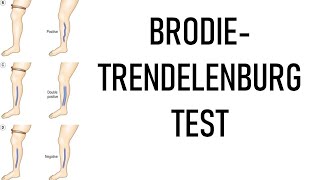 BrodieTrendelenburg Test examination of varicose veins [upl. by Akinna]