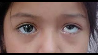 VERTICAL STRABISMUS  Introduction and Comitant Vertical Strabismus [upl. by Efthim]