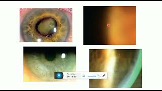 anterior uveitis clinical features [upl. by Suciram]