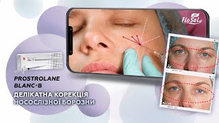 Делікатна beautyкорекція носослізної борозни ревіталізантом💉 Prostrolane BlancВ [upl. by Maryn]