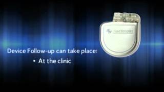 What is an Implantable Cardioverter Defibrillator ICD [upl. by Rento]