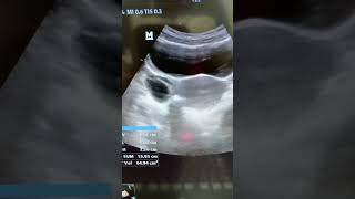 Left Adnexal Simple Cyst ultrasound shortvideo shorts [upl. by Ortrud]