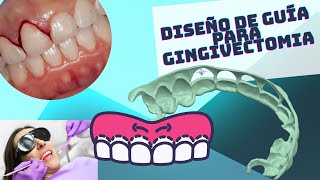 GuÍa para gingivectomia y gingivoplastia Odontologia CAD [upl. by Einre]