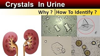 Crystals In Urine  Why amp How to Identify [upl. by Mufinella789]