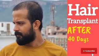 Hair Transplant Shedding After 40 Daysഹെയർ ട്രാൻസ്‌പ്ലാന്റ്LaDensitae Hair TransplantationResult [upl. by Joella]