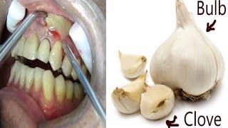 How To Use Garlic For Abscess Tooth [upl. by Prior]