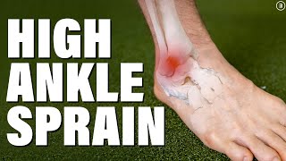 High Ankle Sprain  Syndesmosis Injury Evaluation  Education  Exercises [upl. by Glavin]