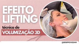 Como fazer o Efeito Lifting com Ácido Hialurônico  Técnica de Volumização 3D [upl. by Etteiluj335]