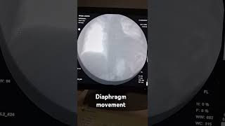 Diaphragm movment fluoroscopy technology anatomy medicalstudent xray hospital [upl. by Sokin]