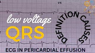 Low Voltage ECG EKG Criteria amp Causes  ECG EKG in Pericardial Effusion [upl. by Karylin945]