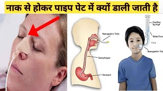 नाक में नाली क्यों और कैसे लगाई जाती है  Nasogastric Tube feeding in hindi [upl. by Ennailuj]