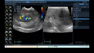 IQ 279 LIVER ULTRASOUND HEPATOMA ECHOPAC ANALYSIS ECHOCARDIOGRAPHY COLOR FLOW MAMMING [upl. by Zetrac]