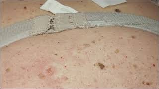 441 Seborrheic Keratosis Removal on Back Janine giving training [upl. by Atsyrt]