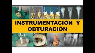 quotINSTRUMENTACION Y OBTURACIÓNquot por el Dr Nestor Jaime [upl. by Araht]