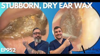 SUPER STUBBORN DRY EAR WAX REMOVAL  EP952 [upl. by Etterb288]