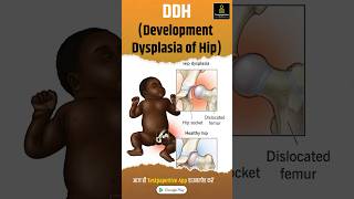 DDH Development Dysplasia of Hip  Pediatric Nursing DDH clubfoot DevelopmentDysplasiahip [upl. by Wendelin626]