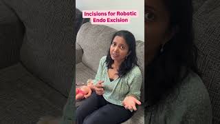 Incisions for robotic endometriosis surgery 🩺Dr Madhu Bagaria Gynecologic Excision Surgeon [upl. by Arrat]