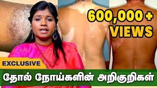 எல்லா தோல் நோய்களுக்கும் இதுதான் தீர்வு  Skin Diseases Treatment in Siddha Thol Noi Pirachanai [upl. by Suh]