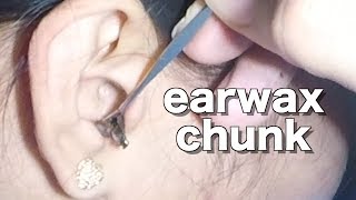 Girls Earwax Chunk Removal [upl. by Tneciv427]