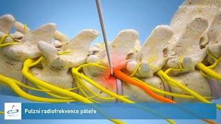 Pulzní radiofrekvence páteře [upl. by Juieta]