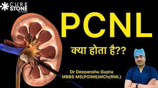 Kidney Stone PCNL  PCNL क्या होता है Kidney Stone Treatment  Percutaneous Nephrolithotomy [upl. by Gnilrets]