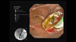 Moderately difficult canulation due to redundant ampulla [upl. by Stockwell]