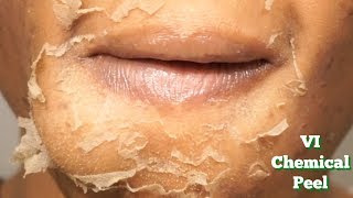 CHEMICAL PEEL Full Process  Procedure  Peeling  Before amp After [upl. by Jeni484]